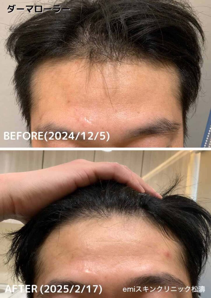 ダーマローラー® ビフォーアフター（育毛）