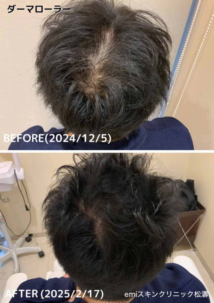 ダーマローラー® ビフォーアフター（育毛）