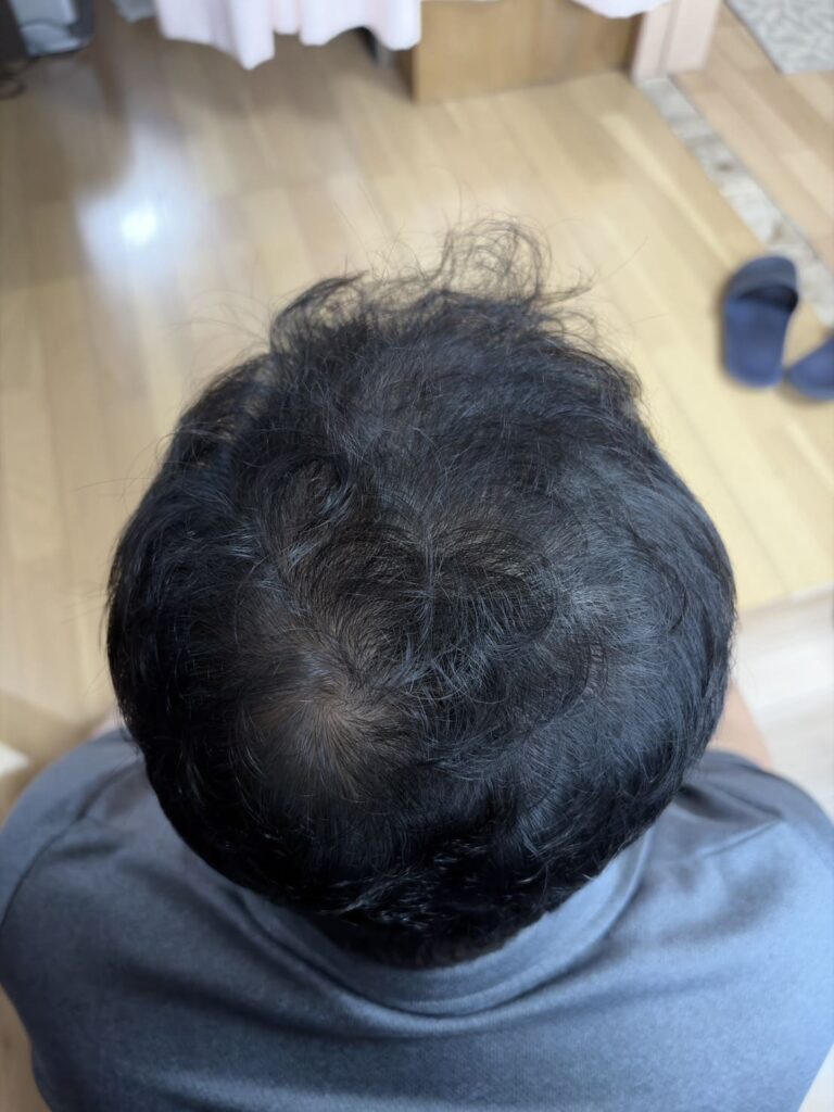 ダーマローラー® ビフォーアフター（育毛）