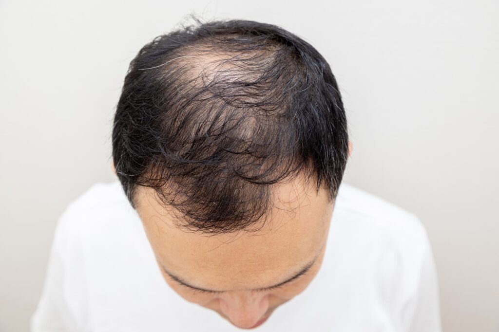 薄毛 対策