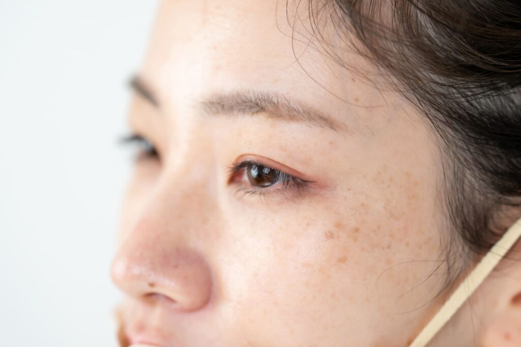 シミ 種類
