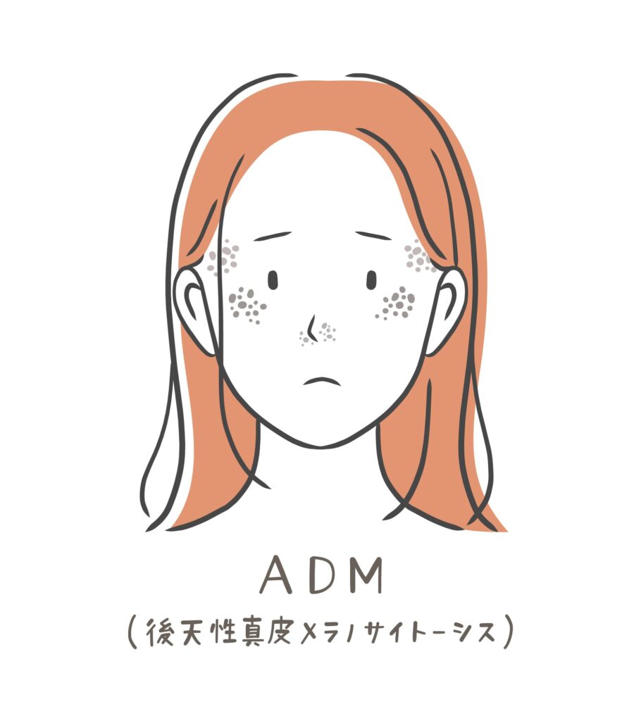 シミ 種類