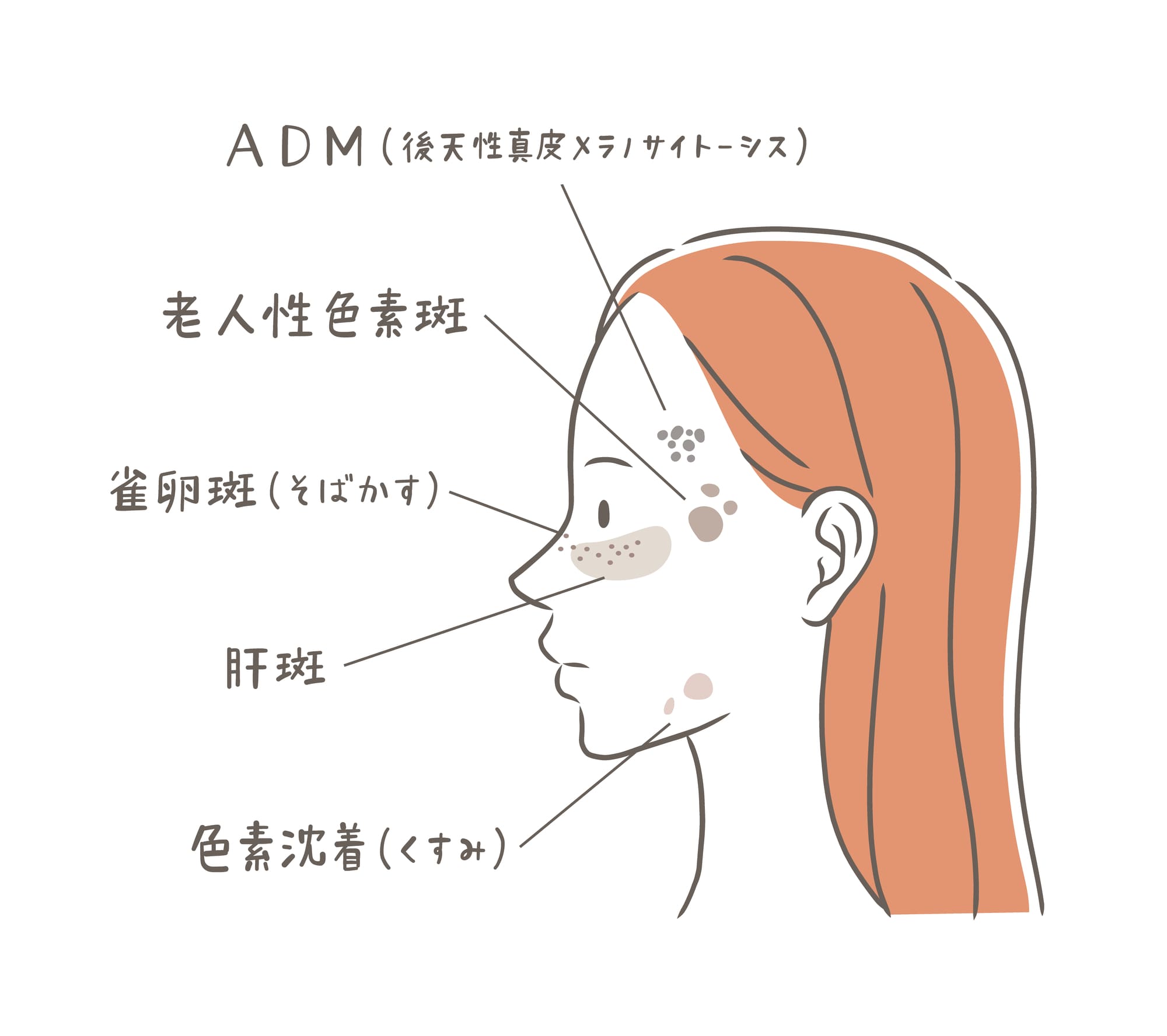 シミ　種類
