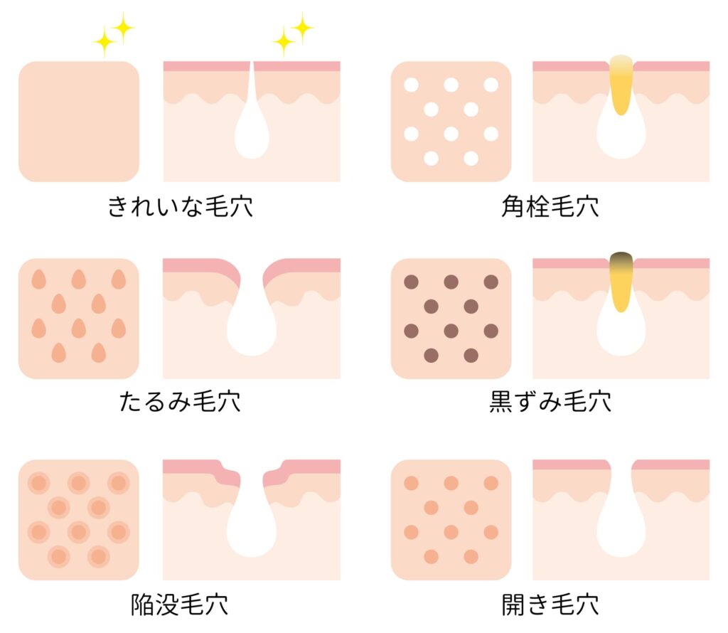 毛穴 たるみ